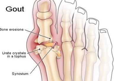 benh gout
