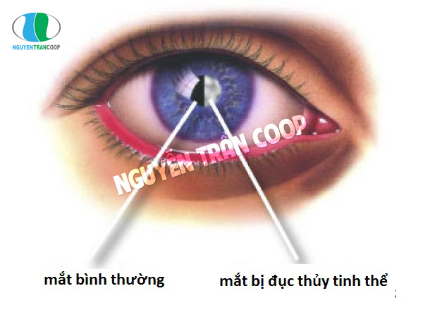 Đục thủy tinh thể là bệnh về mắt thường gặp ở người cao tuổi