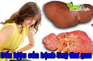 dau-hieu-nhan-biet-ung-thu-gan