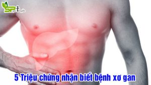 trieu-chung-nhan-biet-benh-xo-gan