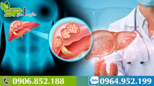 cach-phat-hien-som-benh-ung-thu-gan