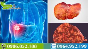 nguyen-nhan-dan-den-benh-ung-thu-gan