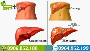 nguyen-nhan-dan-den-benh-xo-gan