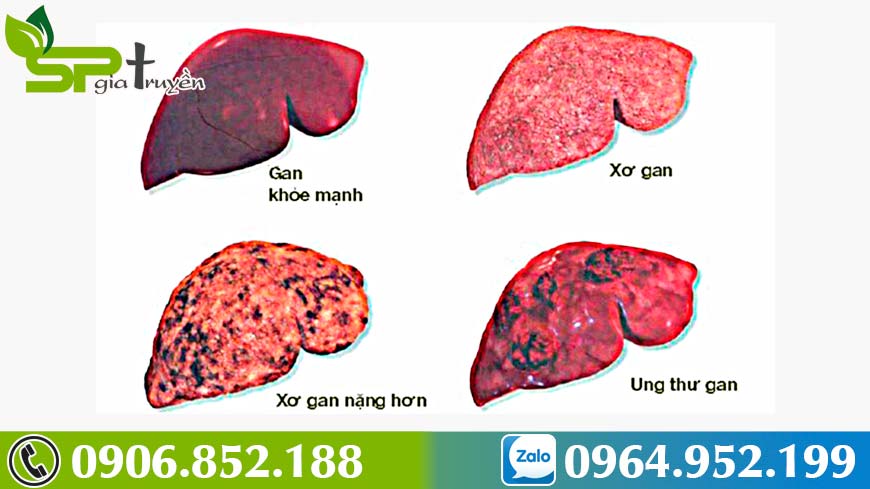Cách phát hiện sớm và phòng ngừa bệnh xơ gan - Sản Phẩm Gia Truyền