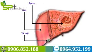benh-ap-xe-gan-co-lay-khong