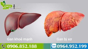 benh-xo-gan-co-lay-khong