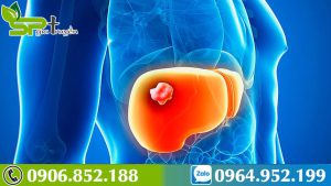 cach-chua-tri-benh-u-gan