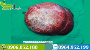 cach-dieu-tri-benh-u-mau-trong-gan-1