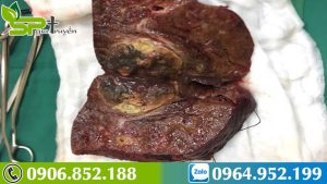 nguyen-nhan-va-cach-phong-benh-u-gan