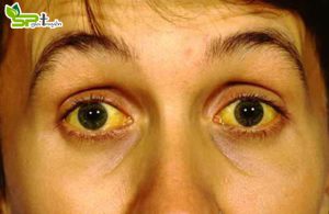 bieu-hien-cua-benh-gan-yeu-1