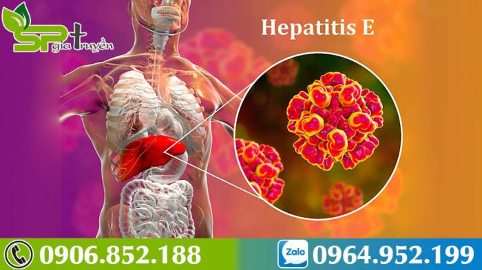 dieu-tri-viem-gan-e