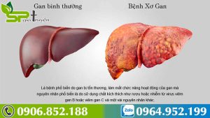 tiet-lo-bai-thuoc-dan-gian-tri-benh-xo-gan