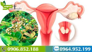 xa-den-giai-phap-cho-benh-nhan-mac-u-xo-co-tu-cung-23jpg