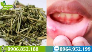 cach-chua-nhiet-mieng-dung-cay-bim-bip-xua-tan-noi-lo